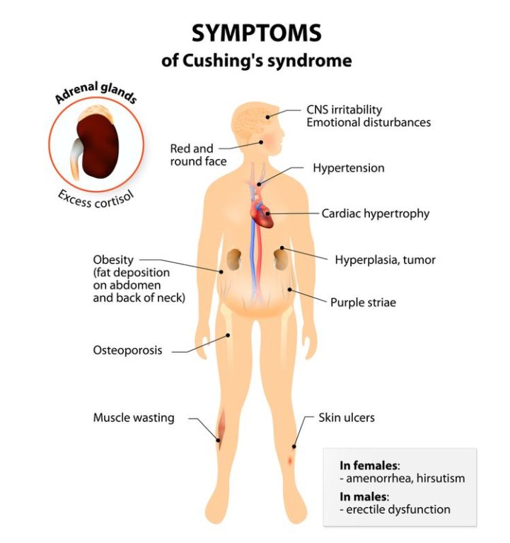 Illustration of symptoms of Cushing's syndrome