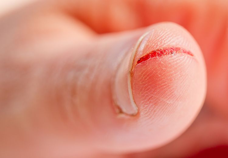 Photo of an Injured Finger With Dirty Open Cut