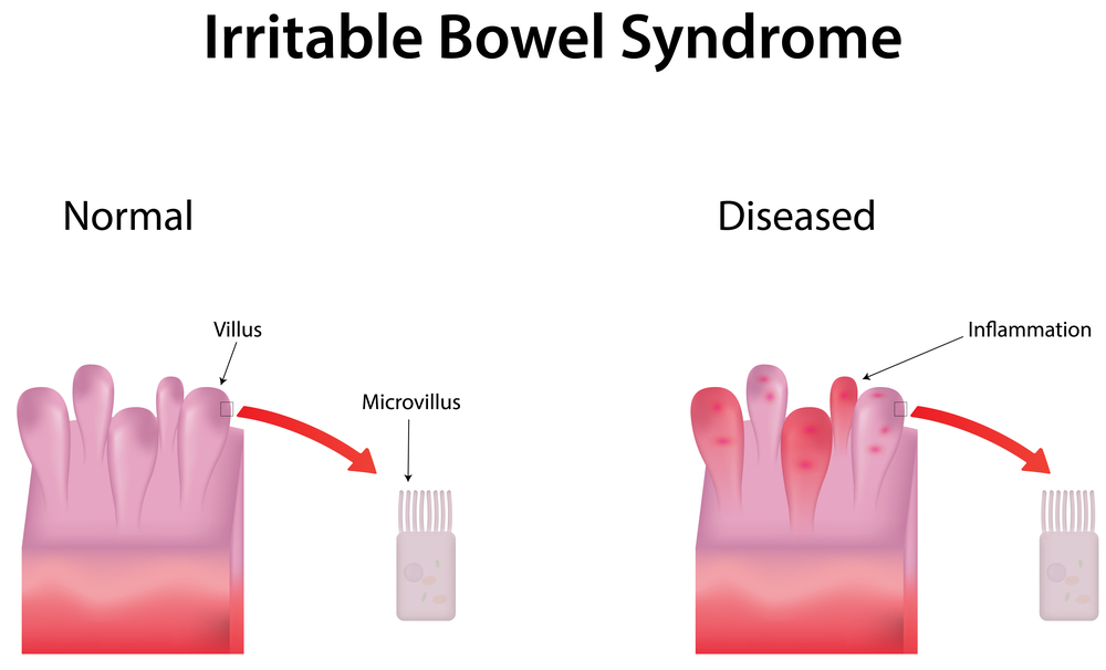 Irritable Bowel Syndrome infographic