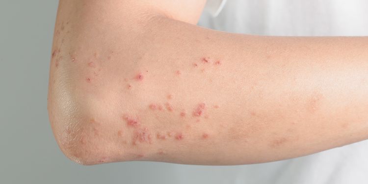 Photo of a skin rash on arm