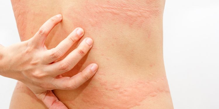 Photo of woman with symptoms of itchy urticaria scratching her back