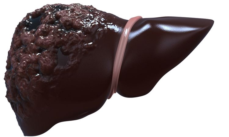 3D illustration of cancerous liver