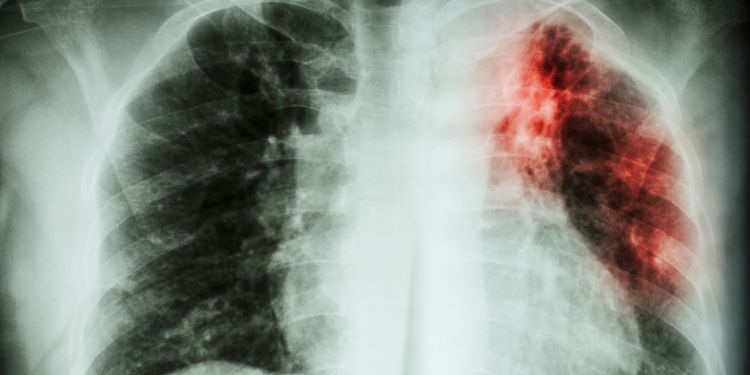 X-Ray photo of Lung Infection 