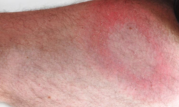 Photo of a bull's-eye rash on a leg- symptom of lyme disease