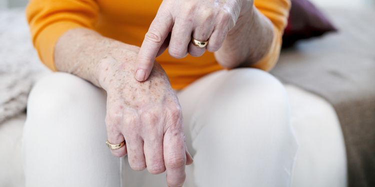 Photo of age spots on senior woman hands