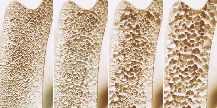 Photo of 4 different stages in bone osteoporosis progression