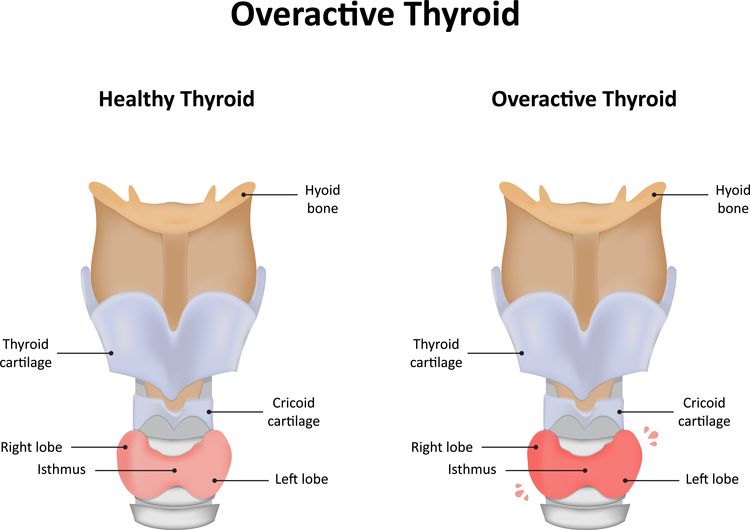 Illustration of overactive thyroid gland