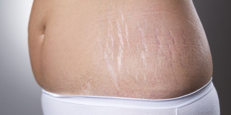 Female belly with pregnancy stretch marks closeup on a gray background