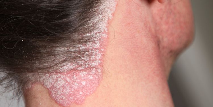 Photo of psoriasis on neck lesion