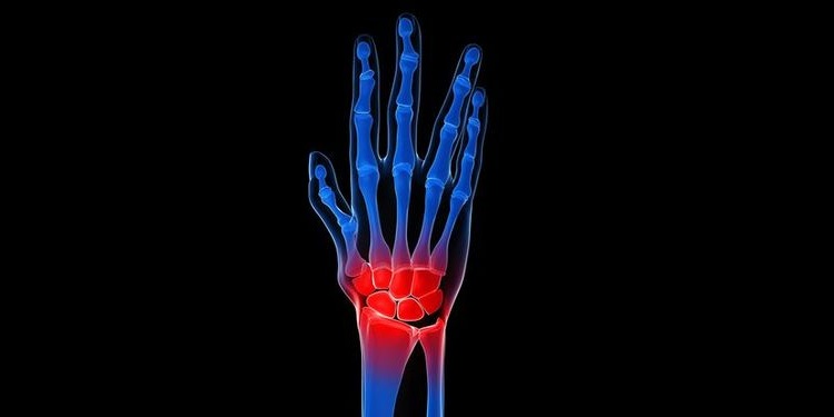 Illustration of a pain in the wrist