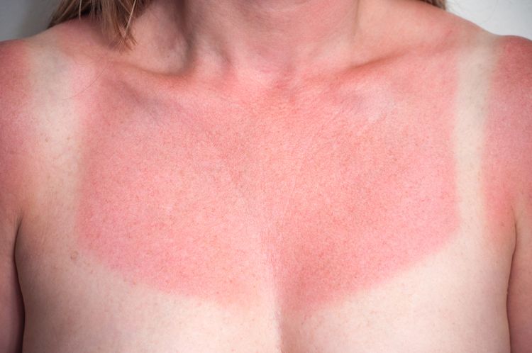 Photo of a Sunburn Skin