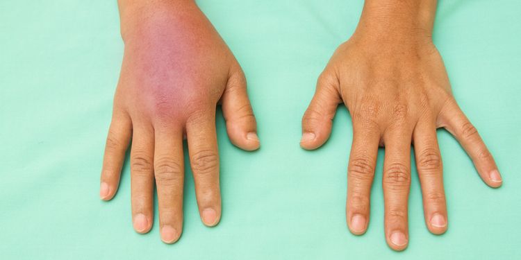 Photo of a swollen inflammed hands