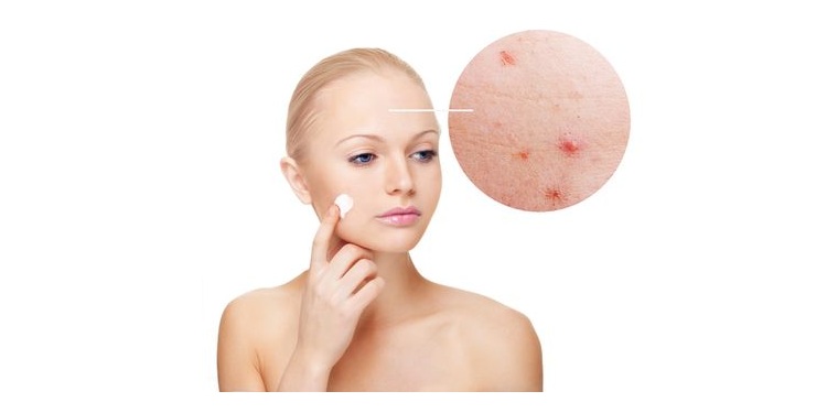 Photo of a girl using acne cream