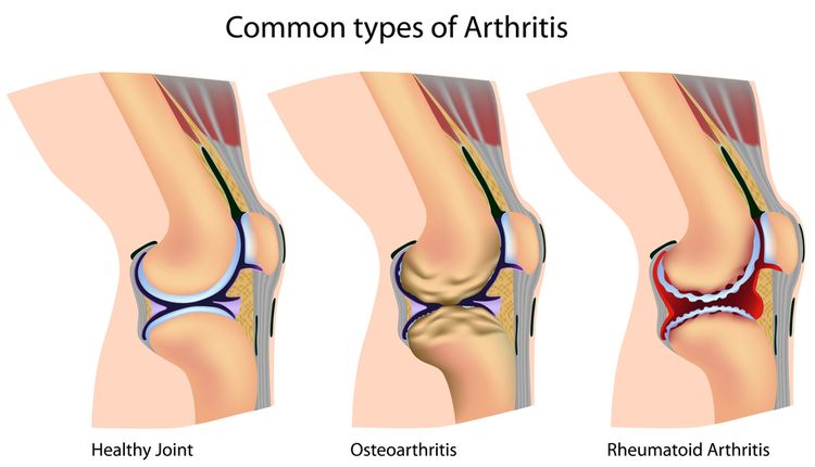 Illustration of joints with arthritis