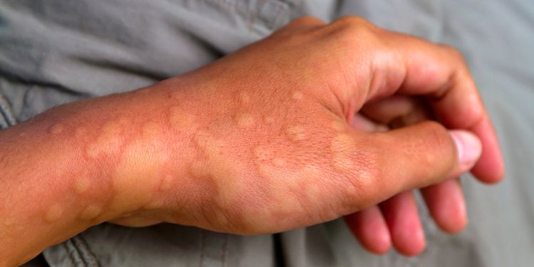 Photo of a hand showing symptoms of urticaria