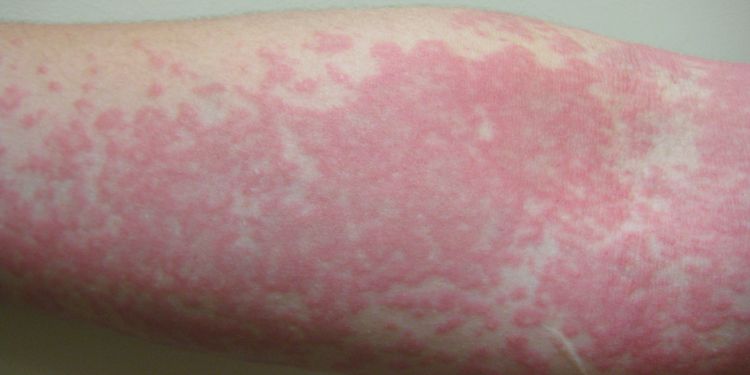 Photo of Symptoms of Urticaria Rash on arm