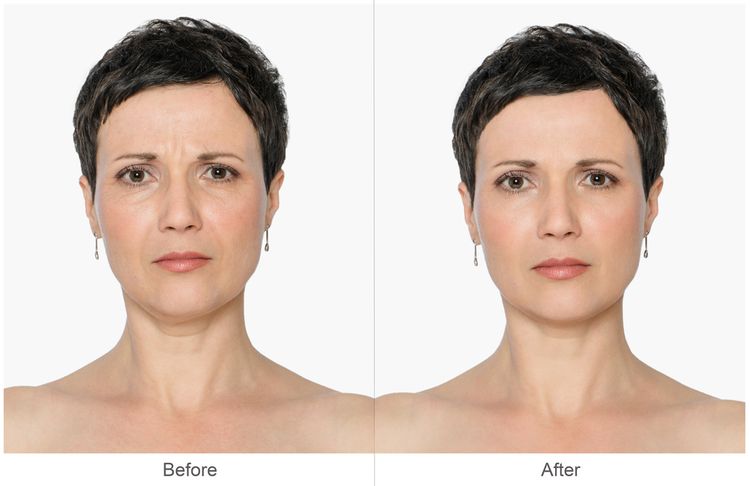 Photo of a woman wih Wrinkles Before and After