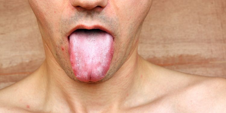 Photo of a man showing his tongue infection