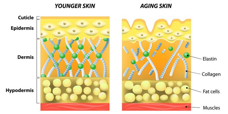 A diagram of younger skin and aging skin showing the decrease in collagen and broken elastin in older skin