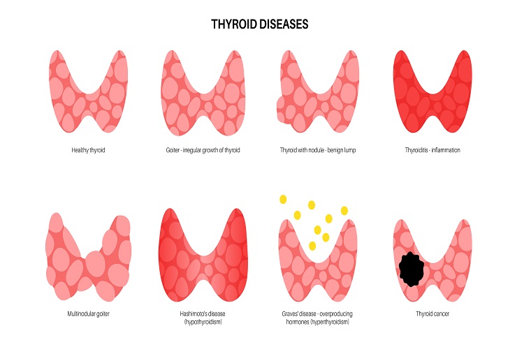 Types of Thyroid Problems